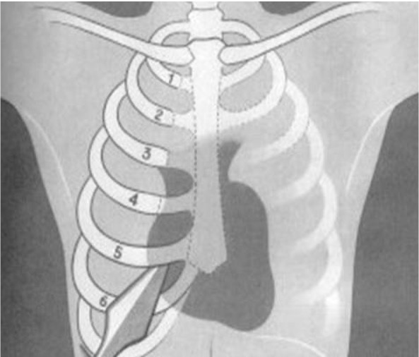 Pierced Side Ribs